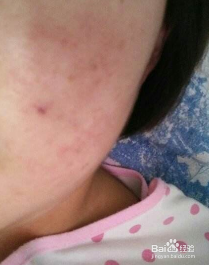 脸上容易长斑是由坏习惯引起的吗