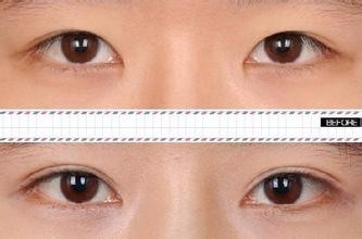 做埋线双眼皮的手术禁忌有哪些