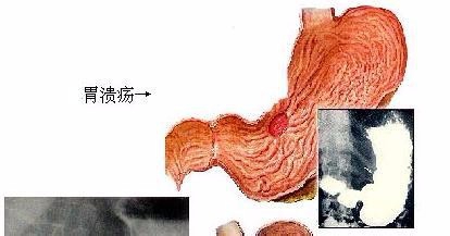 胃溃疡患病的原因与什么有关