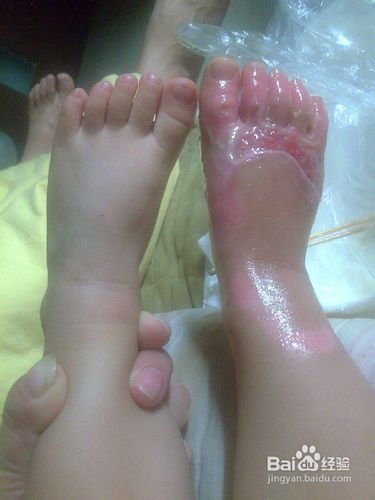 如何去除烫伤疤痕