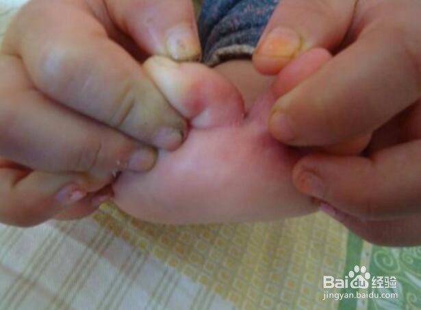 宝宝脚臭有脚气,家长应该怎么给孩子调理呢?
