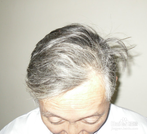 为何年纪轻轻就白发？赶紧看看什么原因吧！