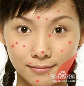 怎么防止治脸上长痘痘