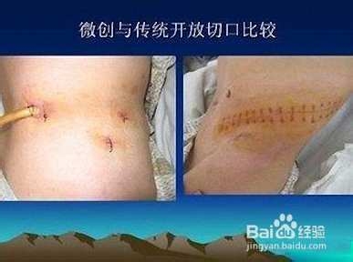治疗宫颈癌选择什么样的手术好
