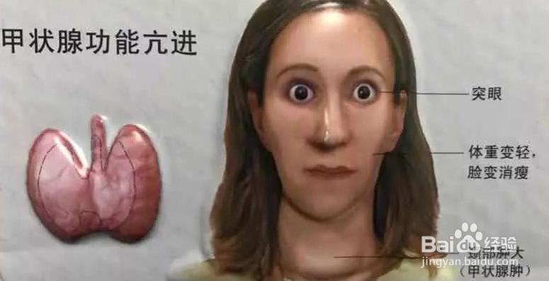 甲亢吃什么水果好