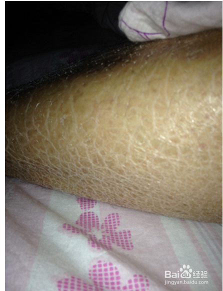 冬天腿部干痒怎么办