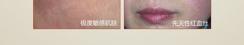 红血丝肌肤的保养方法