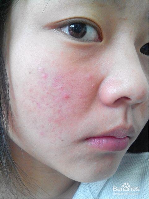 阿莫西林的这些生活小妙招真让人吃惊