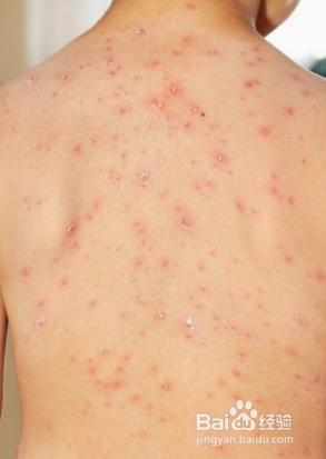 成人斯蒂尔病的皮疹危害