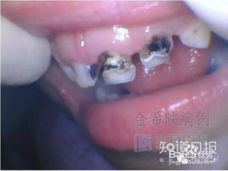 孩子六龄齿窝沟封闭有必要吗?九成父母都不知道