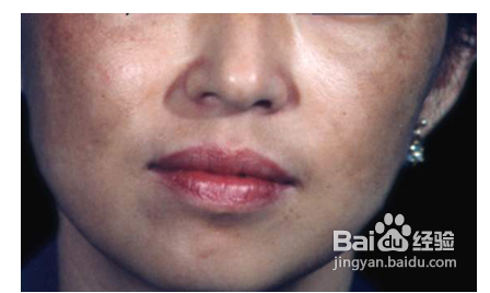 纯天然祛斑方法