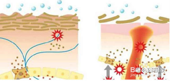 如何去除背部痘痘？