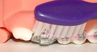 <b>牙齿矫正后的清理方法与技巧</b>