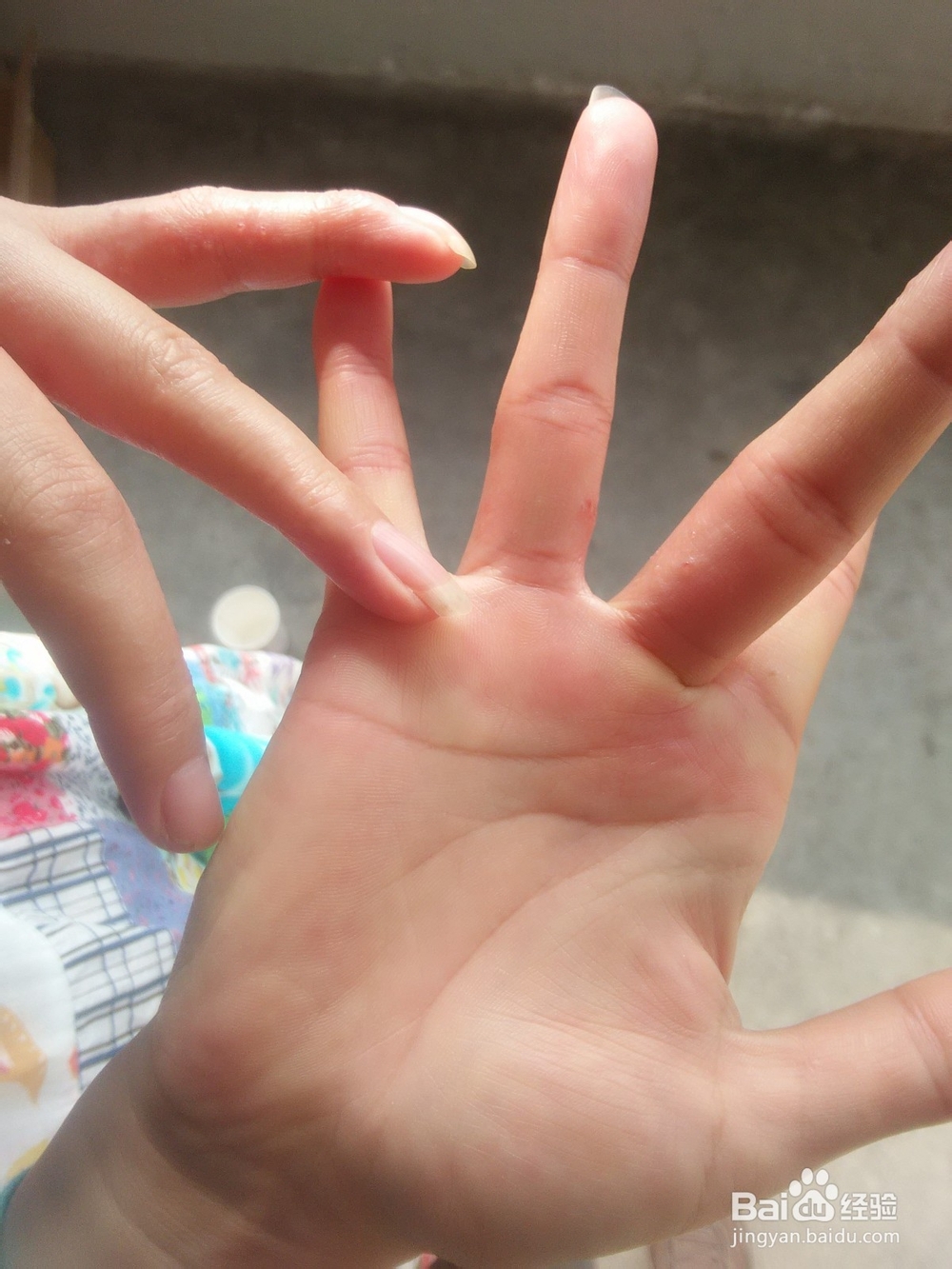 分享手上长水泡如何治愈的方法