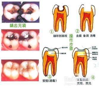 缓解牙痛的方法