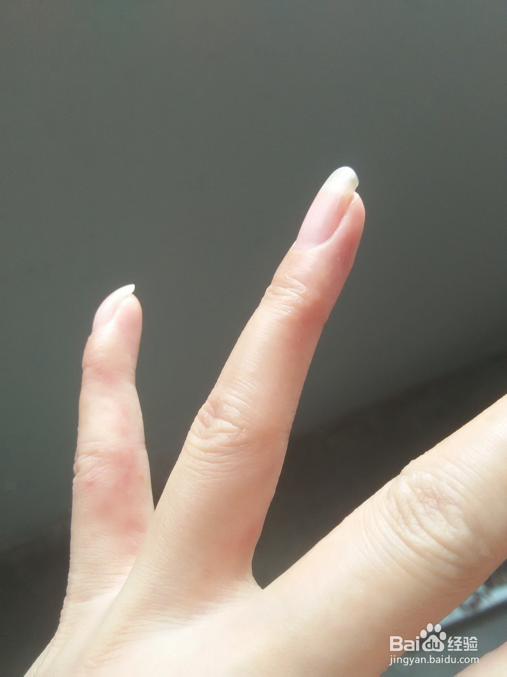 分享手上长水泡如何治愈的方法