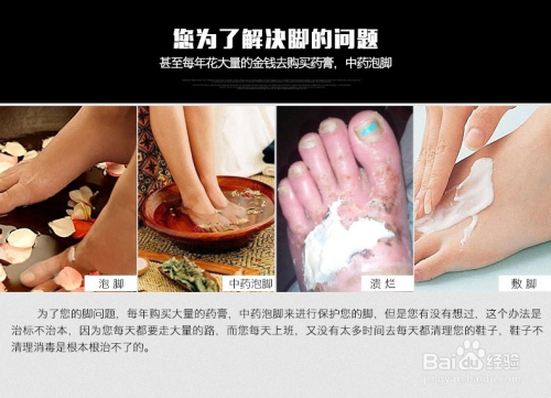 香港脚的常年治疗无效是什么原因?