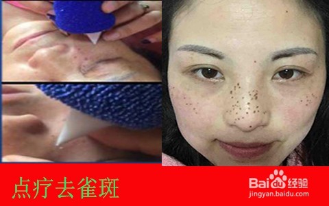 牙膏如何去斑/牙膏能祛雀斑吗