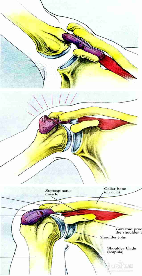 如何进行肩关节的特殊查体