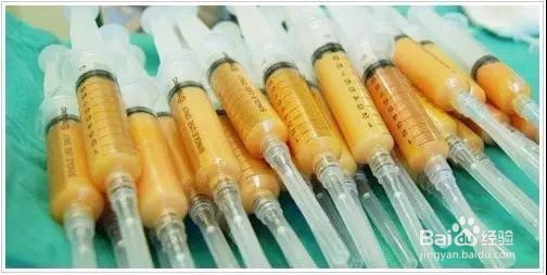 小悦的面部自体脂肪填充经历，掌握变美技巧