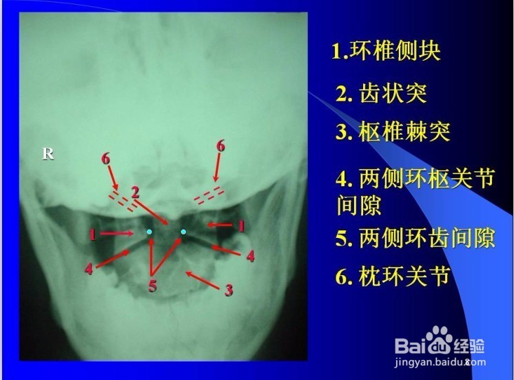 脊椎病的诊断与观片方法