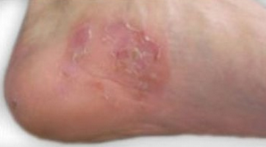 白醋泡脚治脚气