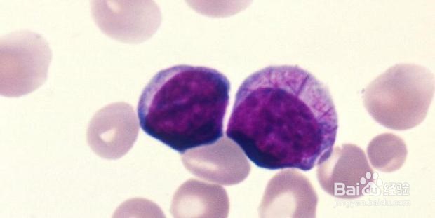 白血病的早期症状都有哪些