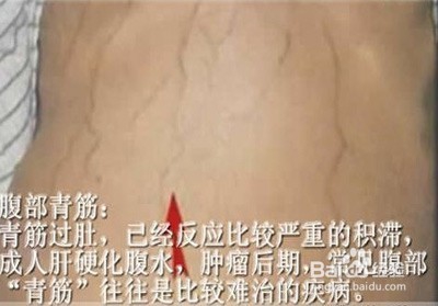 这个部位“青筋暴突”,可能你的肝已经硬化