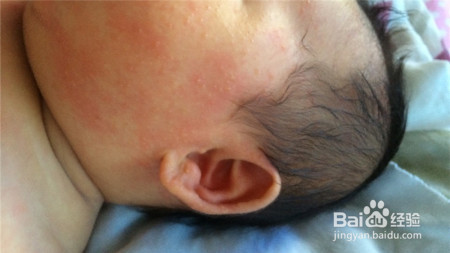宝宝出现湿疹治疗时,应注意哪些?