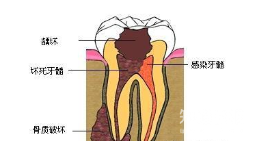 避孕药也能治疗牙疼?