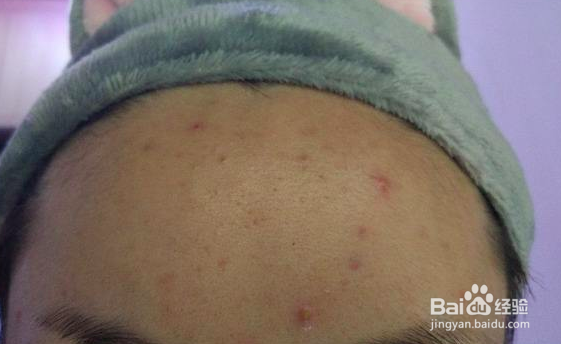 闭口粉刺如何化妆