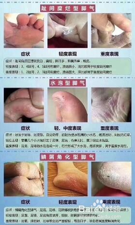 怎样识别不同类型的脚气