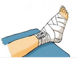 脚扭伤了没骨折要不要治疗呢