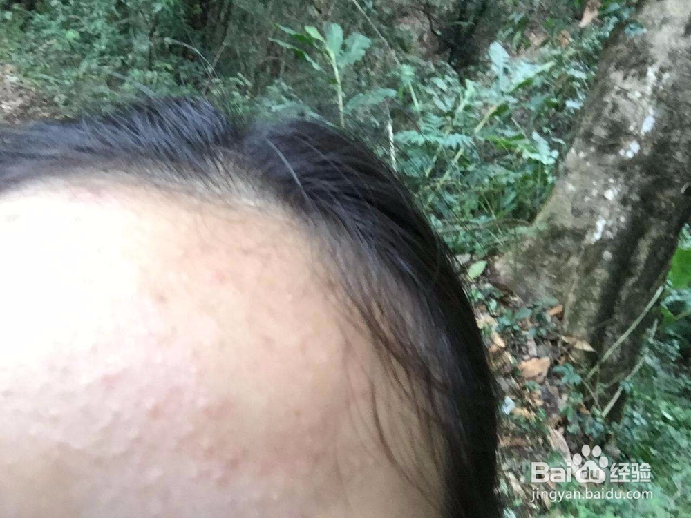 脸上长小疙瘩，可能是汗管瘤，也可能是这些疾病