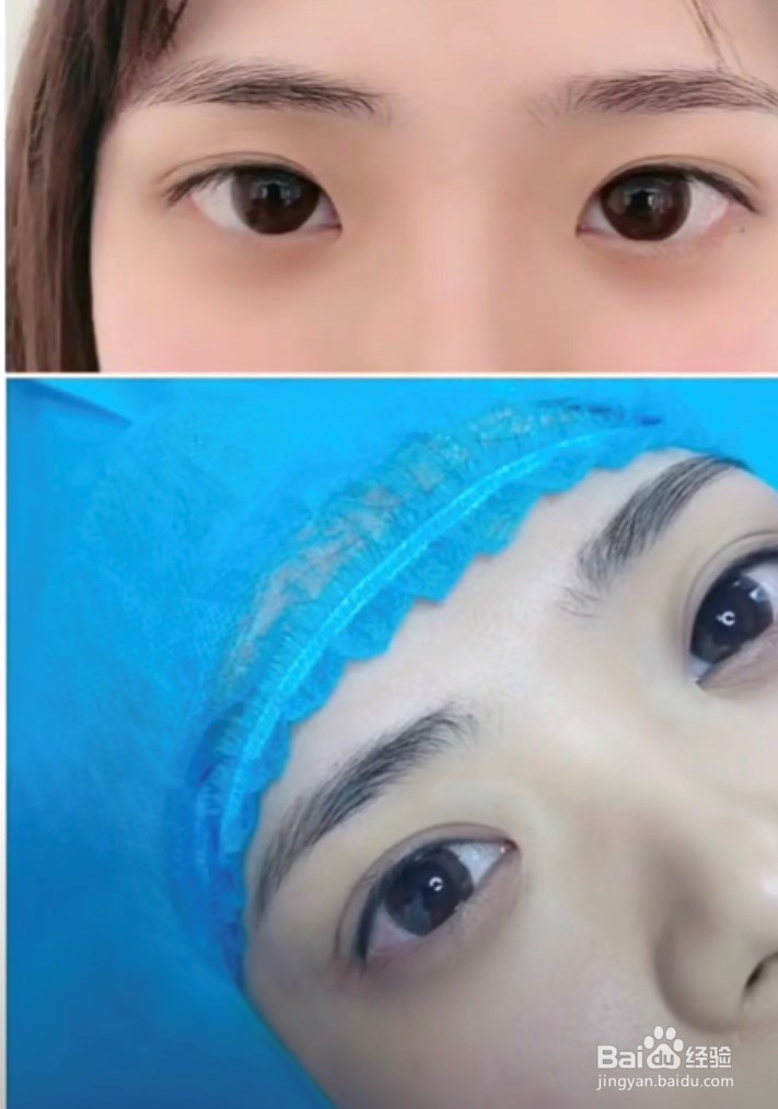 女生必知道的双眼皮术后注意事项