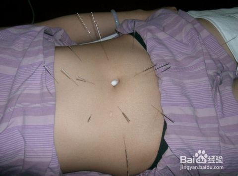 针灸减肥有哪些五个误区