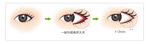 韩式整形：[6]外眼角开大方法好吗