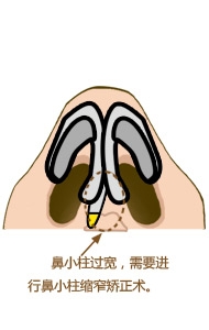 鼻小柱整形解决方案