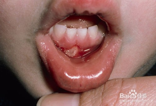 我来告诉你为什么你的口腔总是溃疡？