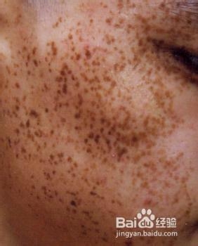 如何预防雀斑