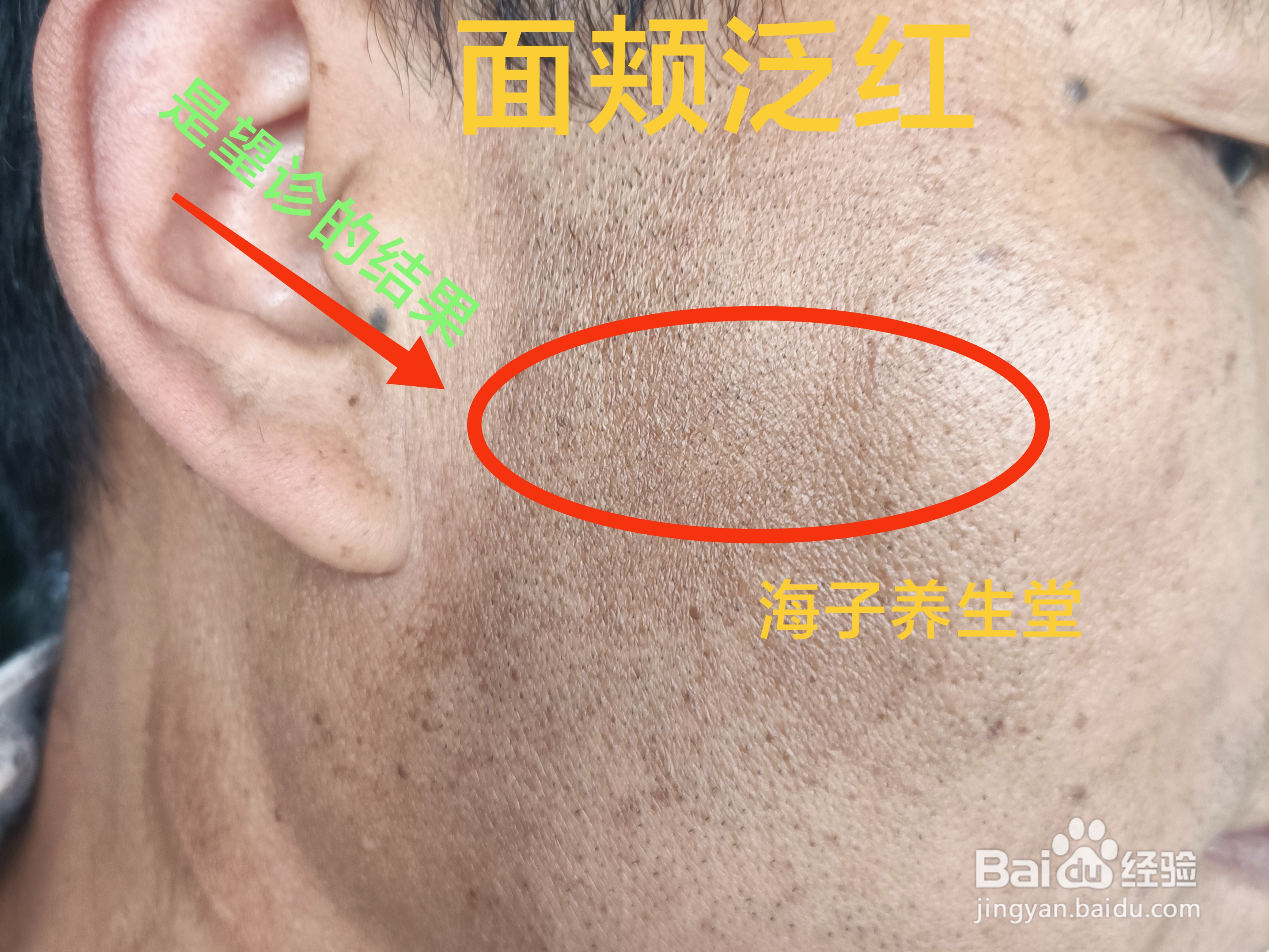 面颊泛红怎么调理