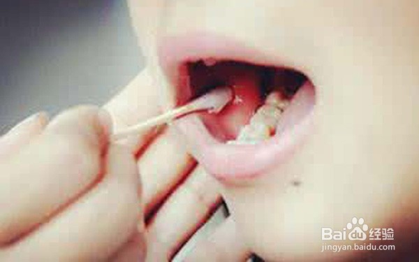 扁平苔藓症状哪些较常见