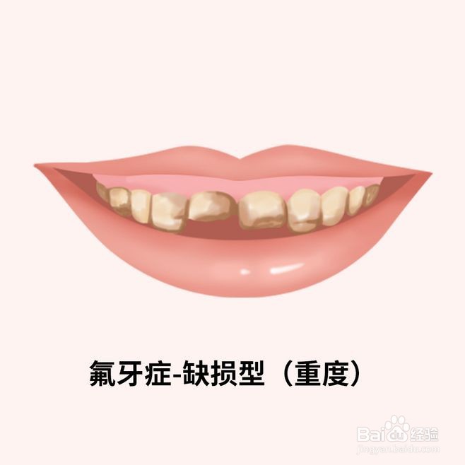 如何治疗氟牙症