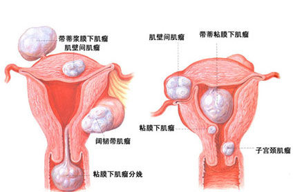 如何自检妇科疾病