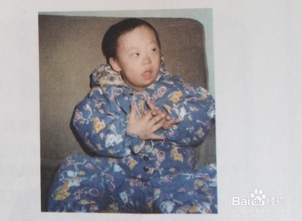 救人一命胜造七级浮屠——您了解苯丙酮尿症吗？