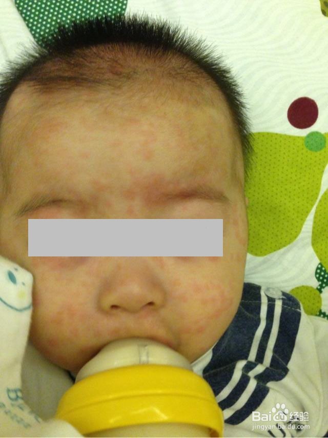 6~18月宝宝突然发烧怎么办？（急疹辨别与处理）