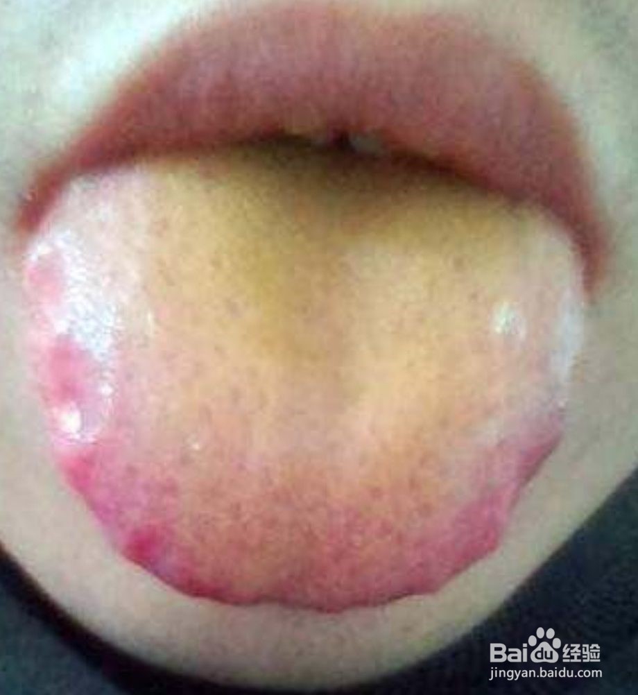 如何判断自己有没有湿气