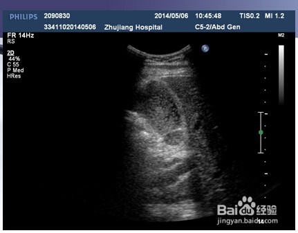 胆道系统几种常见疾病的影像图片。