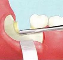 拔智齿过程是怎么样的？