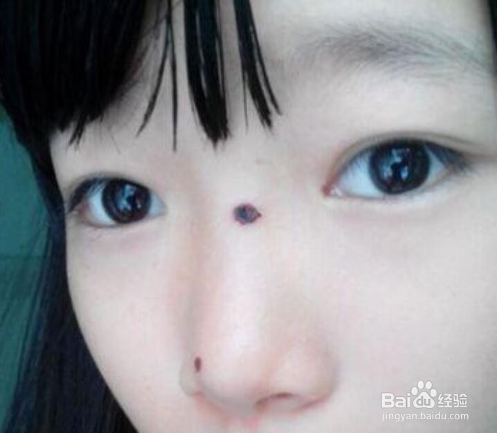 为什么痦子不能随便去掉？有什么危险？